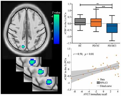 Precuneus Dysfunction in Parkinson’s Disease With Mild Cognitive Impairment